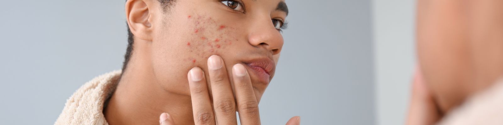 Acné chez l’adolescent : 5 astuces pour prendre soins de sa peau